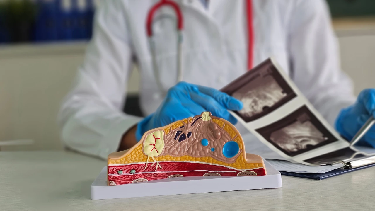 ⁠Sentinel lymph node biopsy