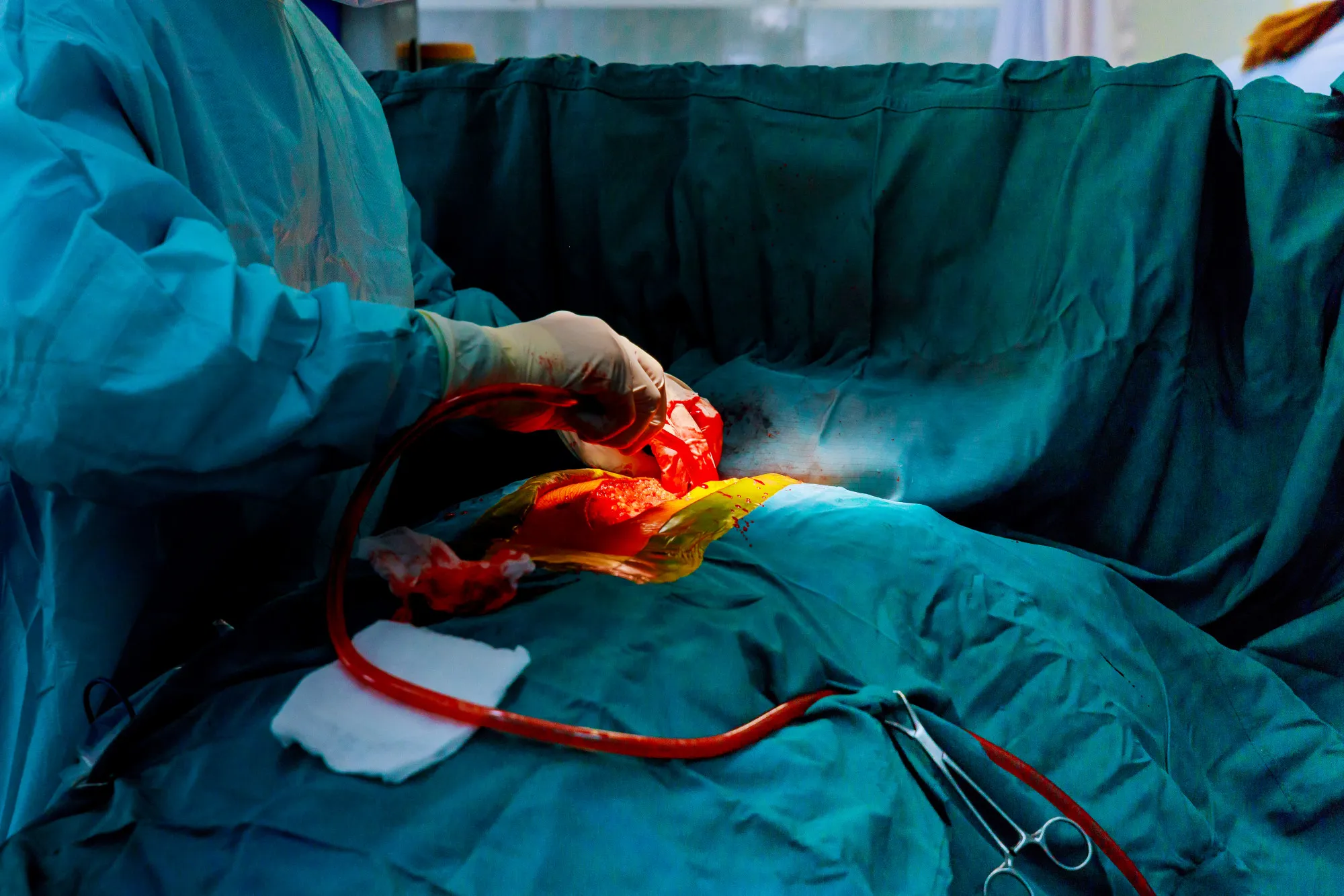 ⁠Organ preservation cancer surgery